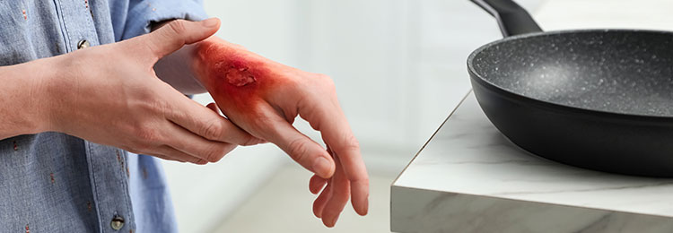 Woman with burn on her hand in kitchen